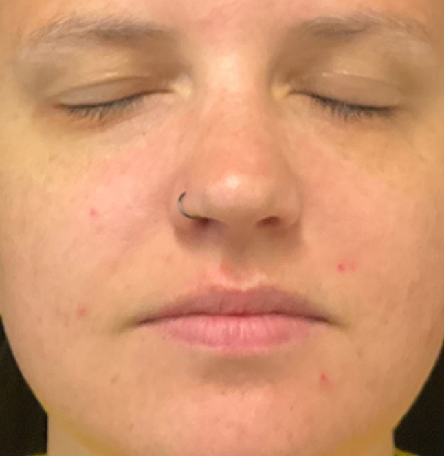 Klar Acne Serum — Week 8
