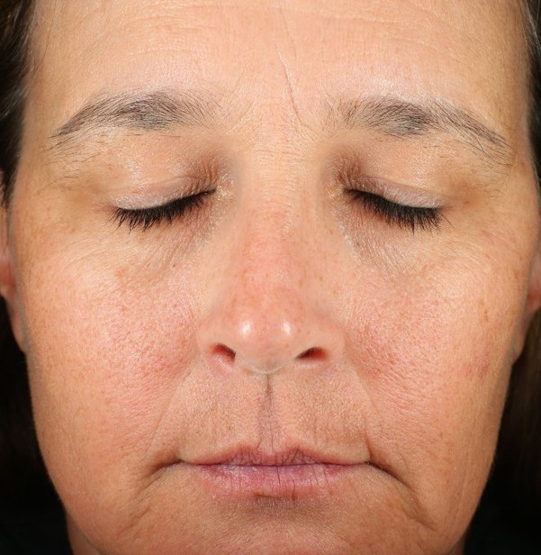 PM Gentle Anti-Aging Serum — Baseline