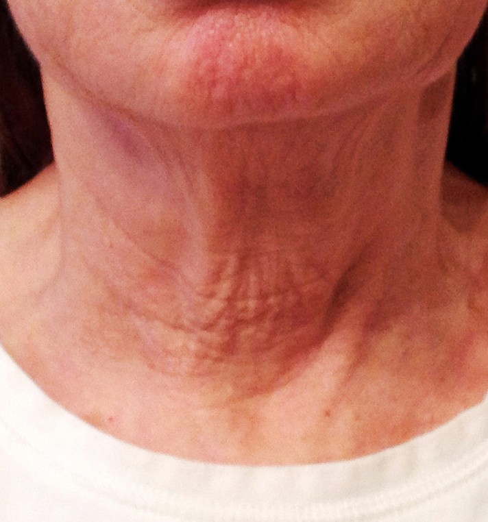 Phyto-Peptide Neck Cream — Week 3