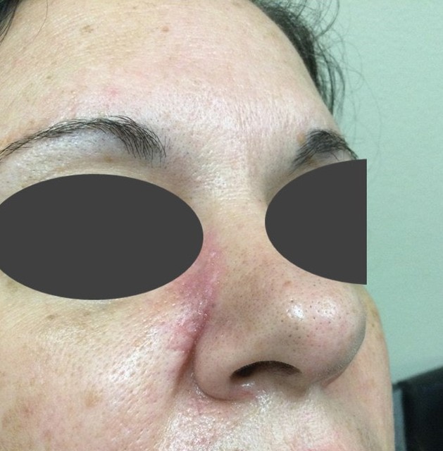 Wound Healing Gel — After 2 weeks