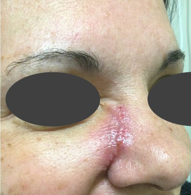 Wound Healing Gel — Before