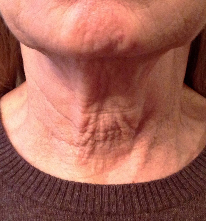 Phyto-Peptide Neck Cream — Baseline