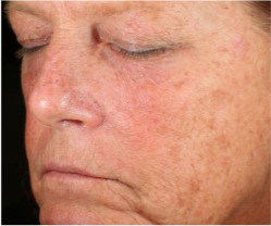 PM Gentle Anti-Aging Serum — Baseline